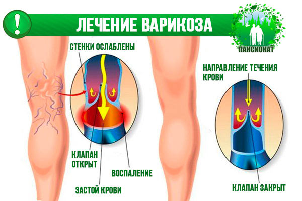 Варикоз Симптомы Профилактика